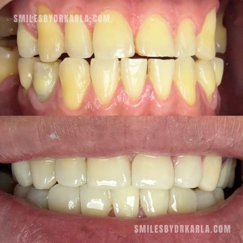 Composite Veneers A1 Shade