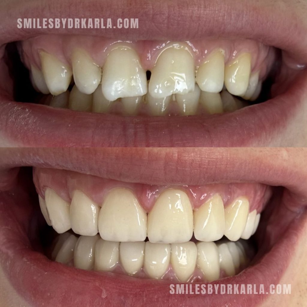 Veneers Emax